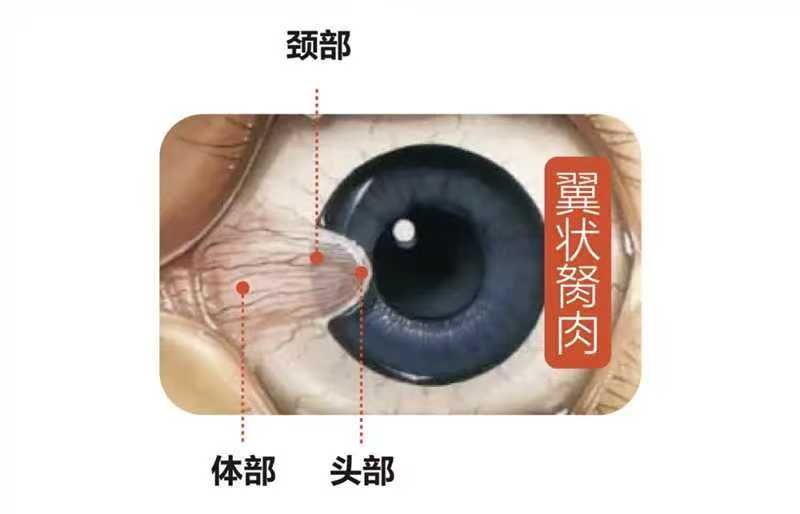 得了翼状胬肉，要切掉吗？