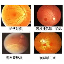 想做近视手术，医生却告诉我眼底先要打激光？
