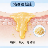 眼睛总有分泌物、眼屎多？警惕睑板腺功能障碍