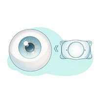 ICL手术为啥这么贵？贵在哪里？一文看懂→